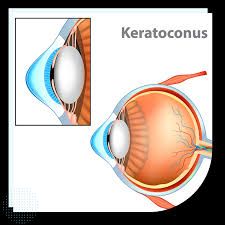 Why Patients Shouldn’t Delay Keratoconus Diagnosis in Reseda