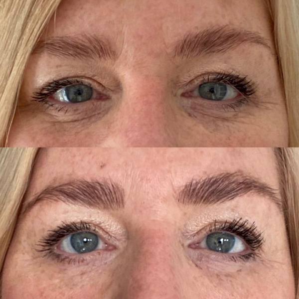 Searching for HIFU Treatment Near Me? What to Check First
