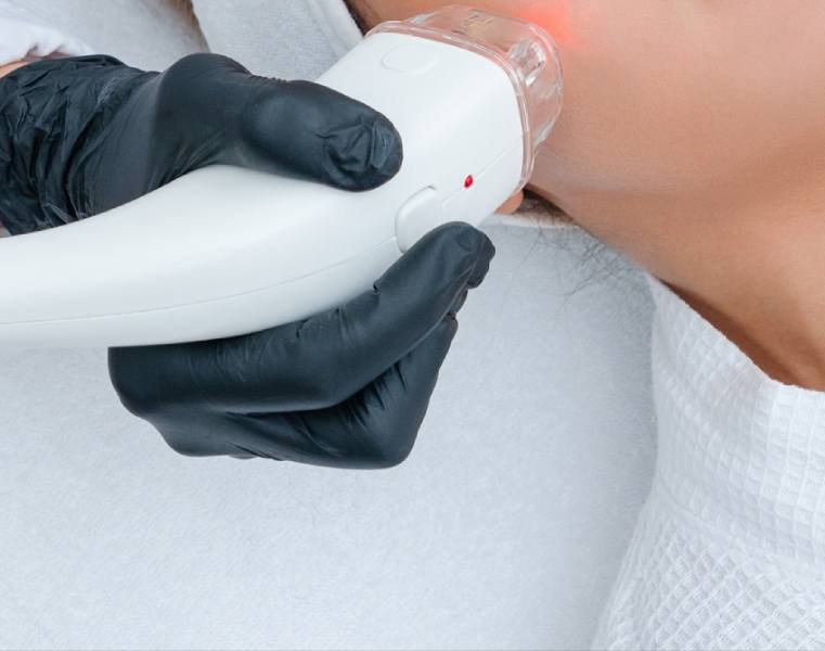 laser resurfacing